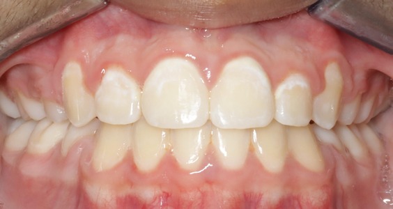 After Teeth